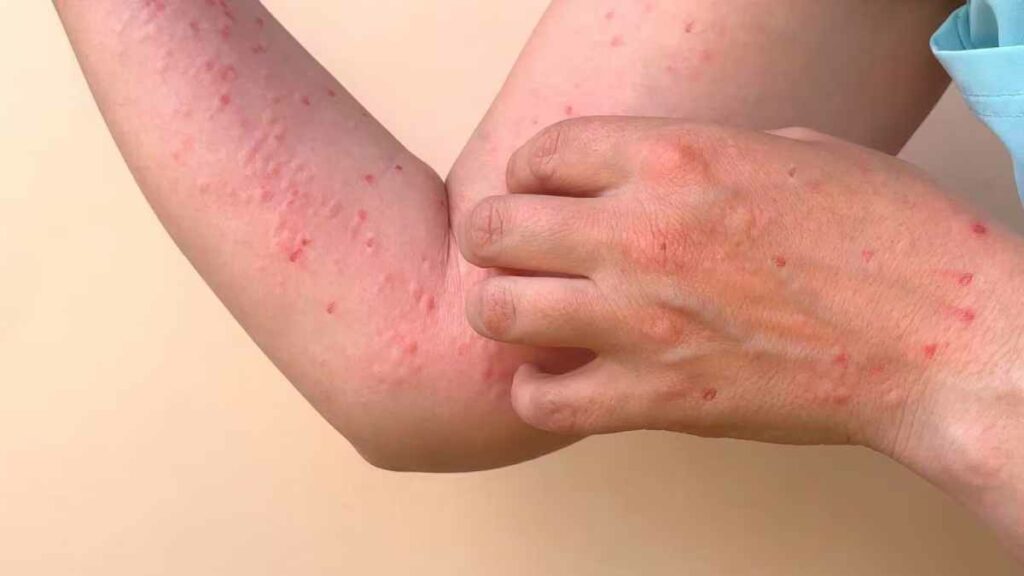 La agencia de salud de la Unión Europea instó a los estados miembros a prepararse para más casos de una cepa mortal de viruela del mono (mpox).