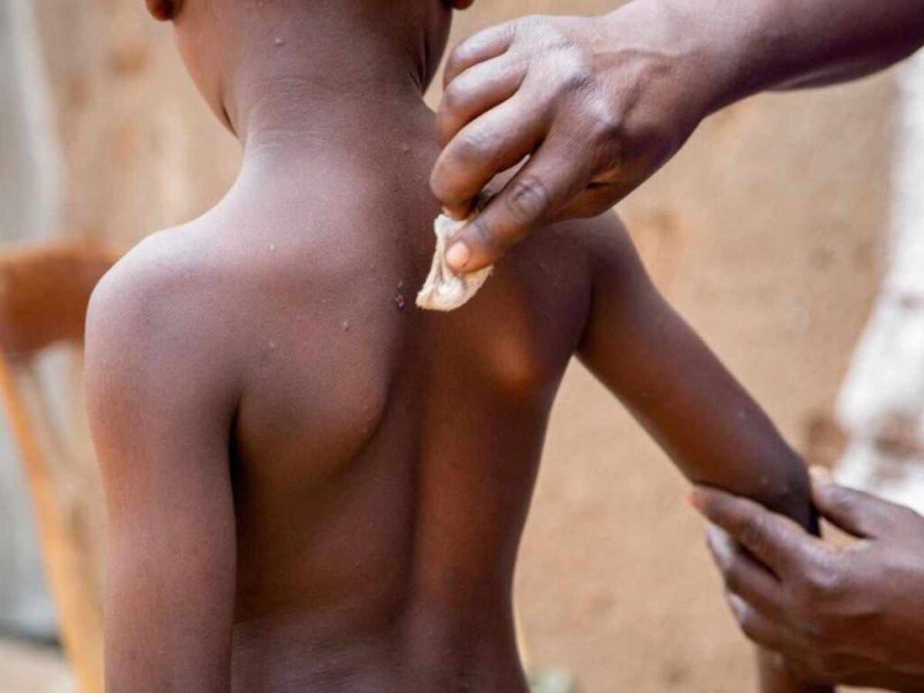 Casi un tercio de los pacientes infectados por la mpox en Burundi, país de África Oriental, tiene menos de cinco años.