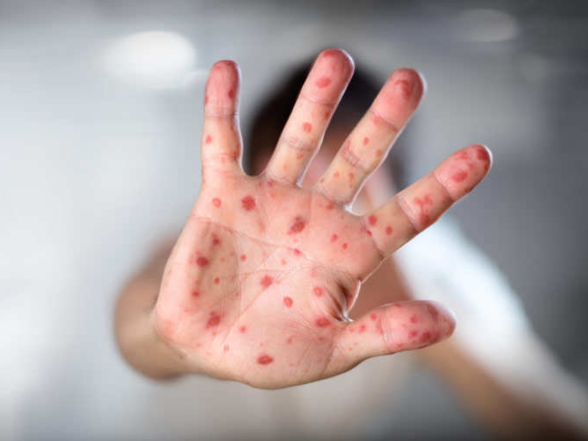 Esta es la cifra de casos de sarampión que ha cobrado la vida de cuatro bebés en el país