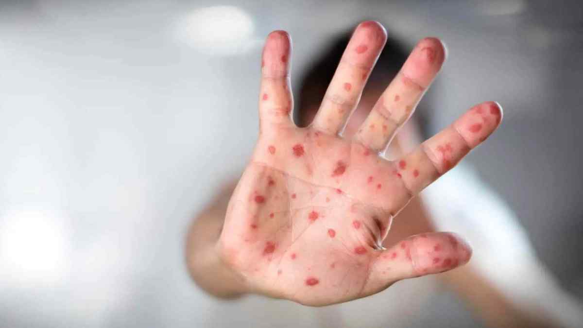 El 88% de casos de sarampión están recuperados, aseguran autoridades de Salud